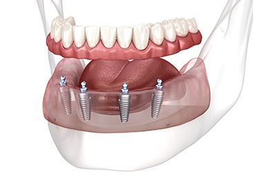 Illustration showing all-on-4 implant dentures