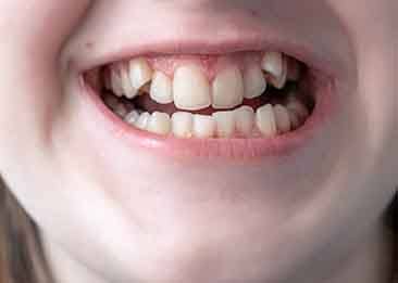 An example of crowded teeth in Downers Grove