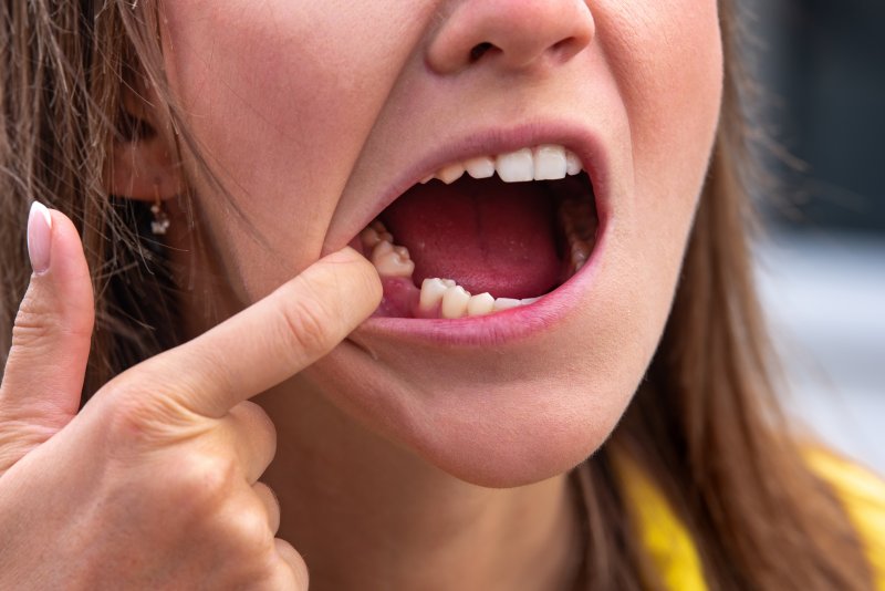 woman looking at missing tooth 