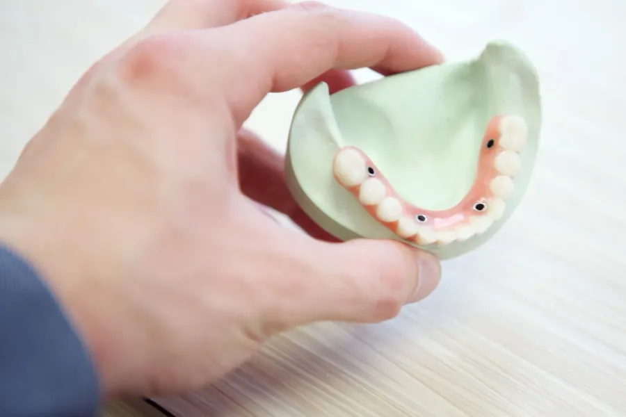 Hand holding a dental jaw model used for restoration planning