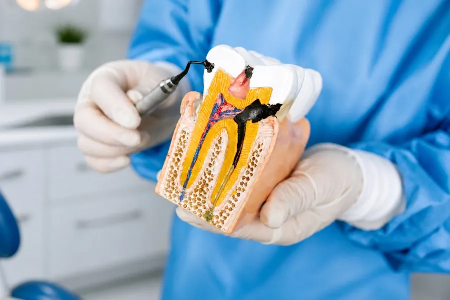 Cross-section model of a tooth showing decay, held by a gloved dental professional