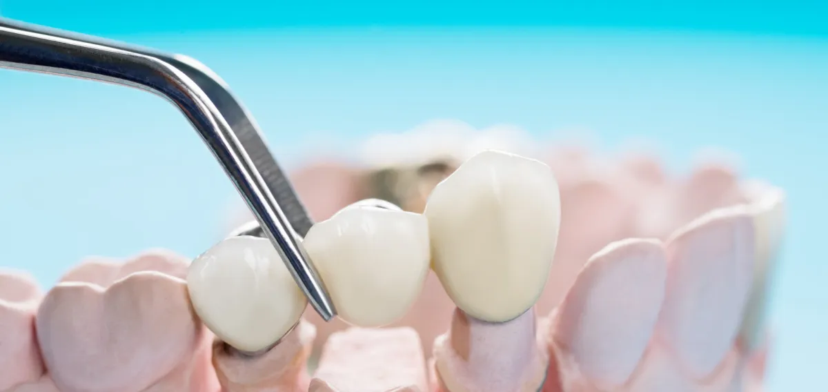 Dental Bridges - Restorative Dentistry Treatment at Dentique Dental Care