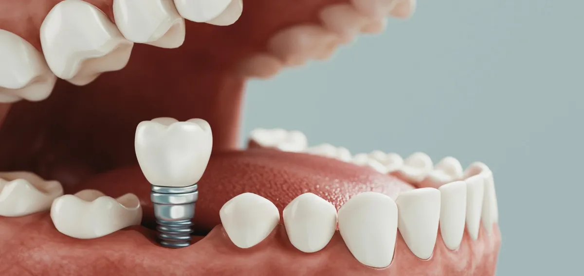 Dental Implant Surgery - Oral Surgery Treatments at Dentique Dental Care