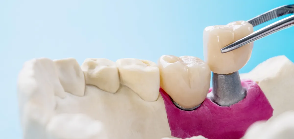 Dental Implants - Restorative Dentistry Treatment at Dentique Dental Care