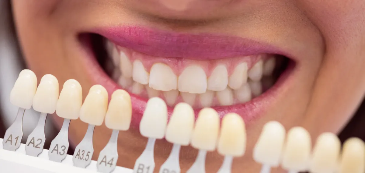 Porcelain Veneers - Cosmetic Dentistry Treatment at Dentique Dental Care