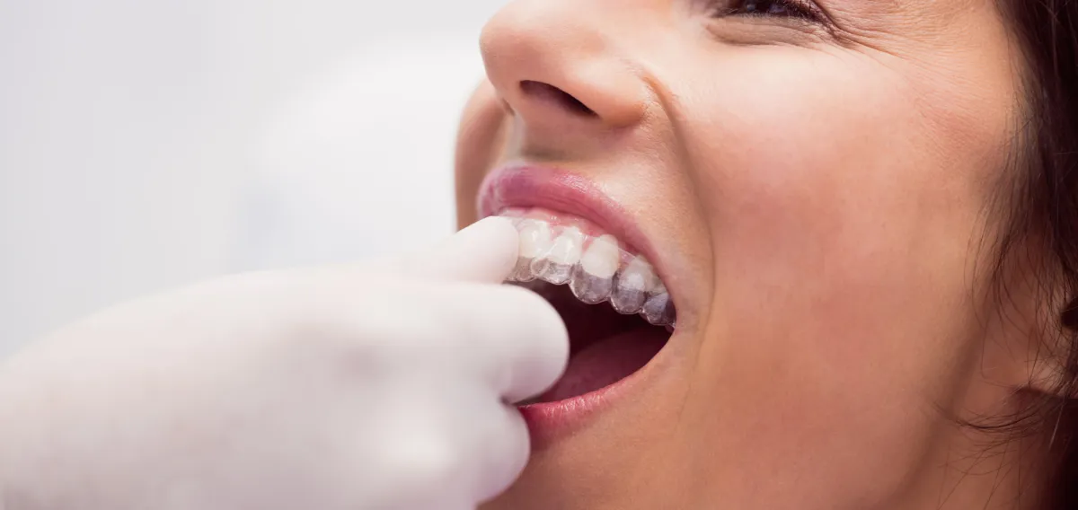 Retainers - Orthodontics Treatment at Dentique Dental Care