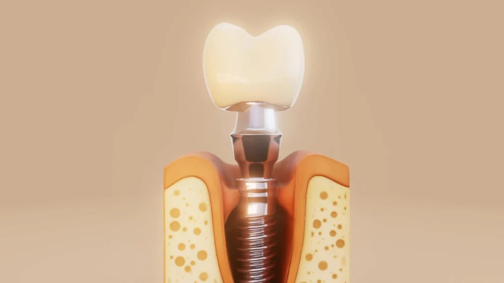 Dentist explaining the dental implant process step by step to a patient using a jaw model