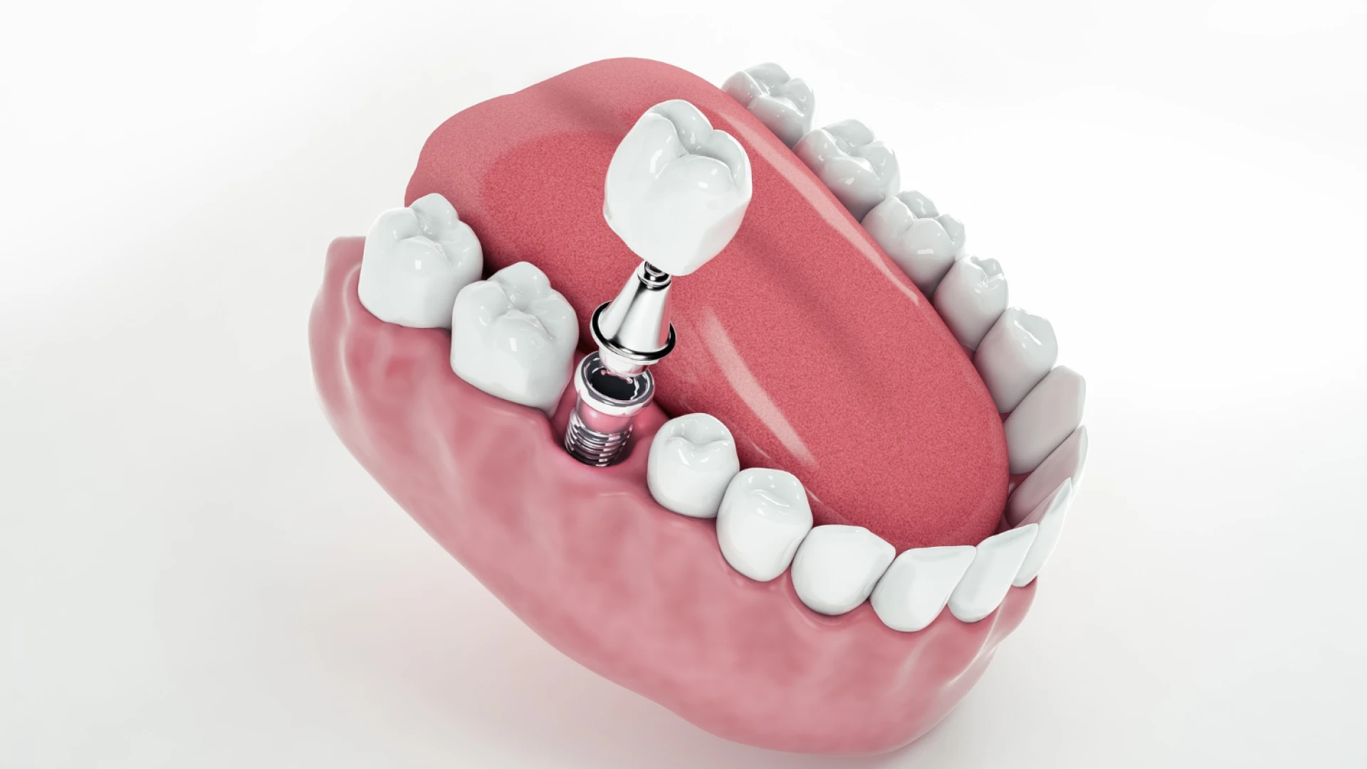 5730 Why Missing Teeth in Downers Grove Get More Expensive Over - Dentique Dental Care