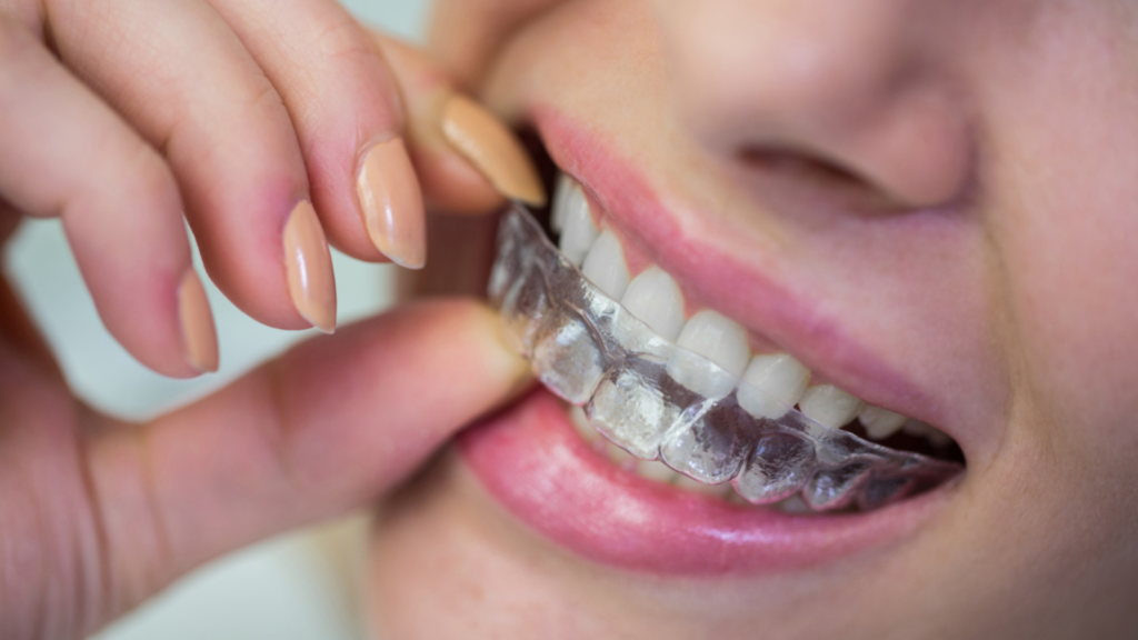 Is Invisalign Worth It for Adults? Clear Aligners Cost, Treatment Timeline & Before and After Results