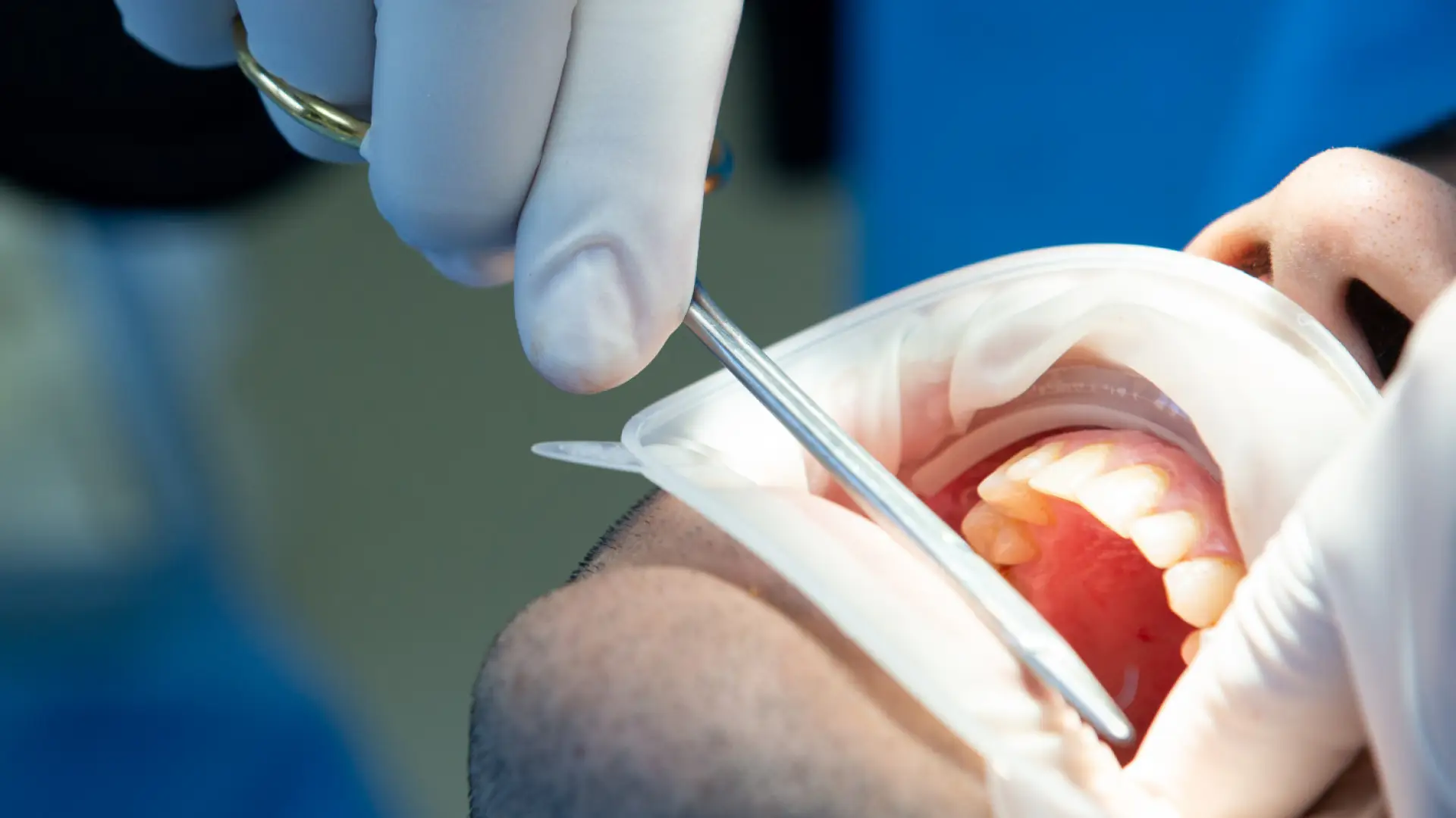 Bone-Grafting-and-Sinus-Lifts-for-Dental-Implants-Do-You-Need-One