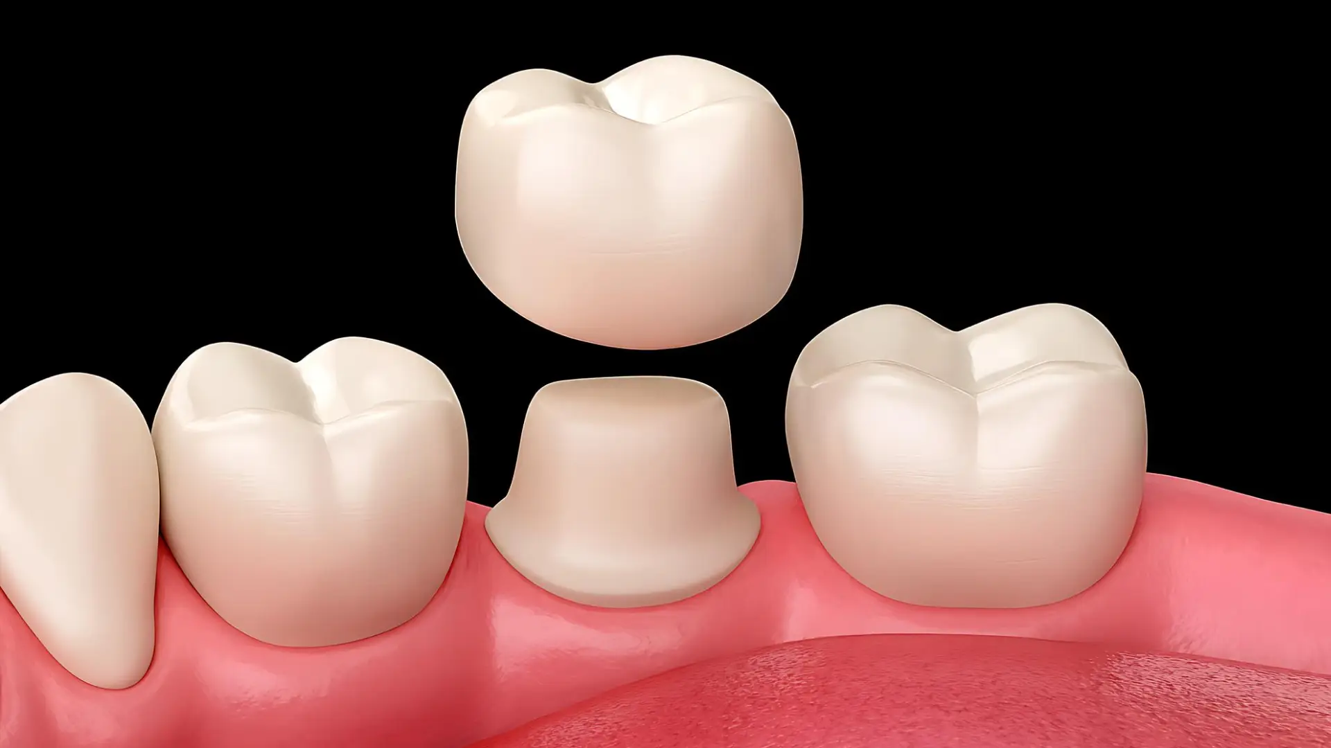 Same-Day-Crowns-Explained-How-CEREC-Restores-Your-Tooth-in-One-Visit