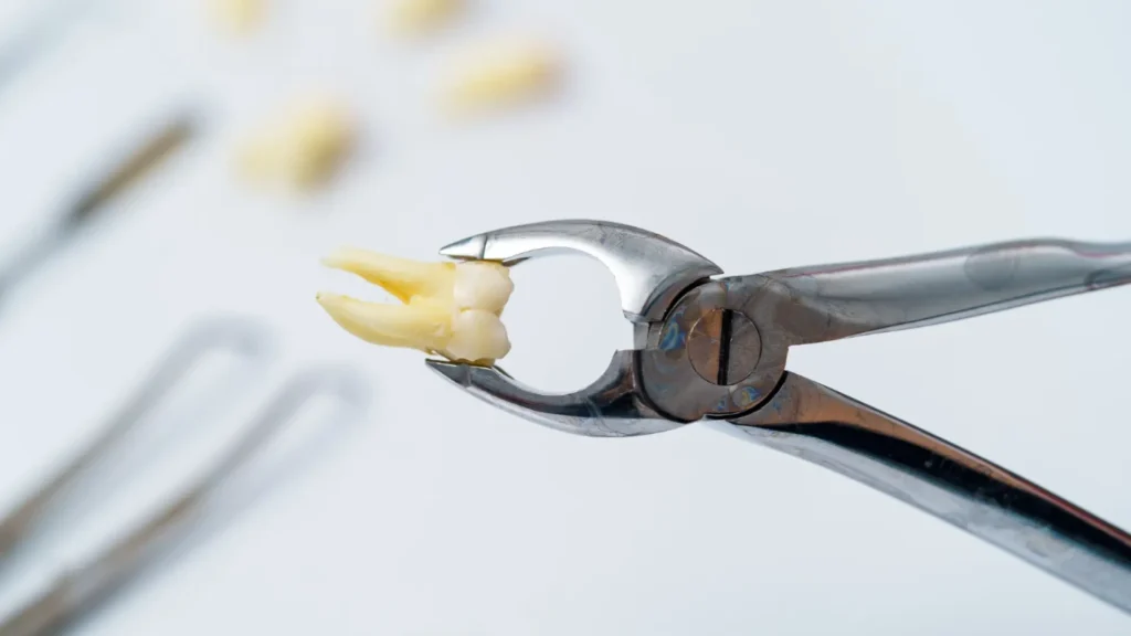 Tooth Extraction Aftercare: Healing Timeline, Dry Socket Prevention & What to Avoid 1 - Dentique Dental Care Tooth-Extraction-Aftercare-Healing-Timeline-Dry-Socket-Prevention-What-to-Avoid.