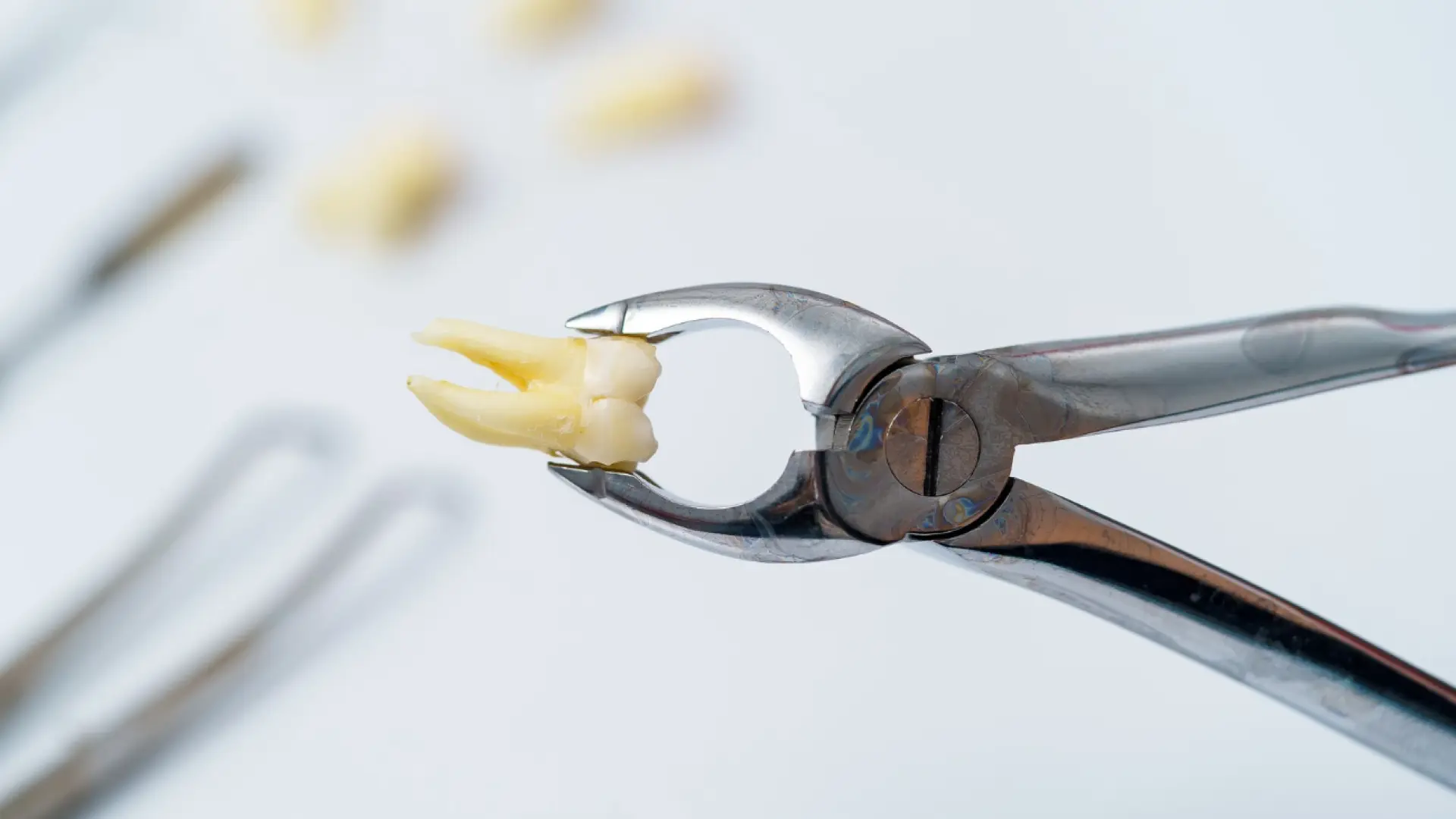 Tooth-Extraction-Aftercare-Healing-Timeline-Dry-Socket-Prevention-What-to-Avoid.